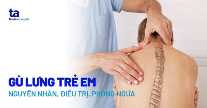 Hình ảnh trẻ bị gù lưng: Nhận diện, nguyên nhân và giải pháp toàn diện