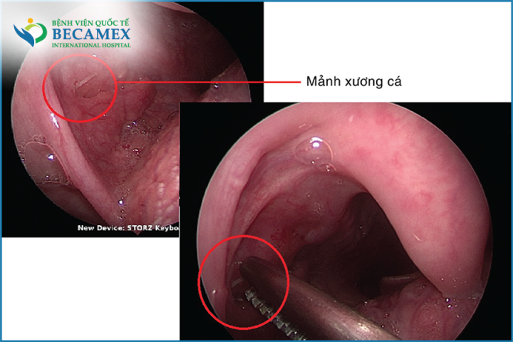 Cách Xử Lý Khi Bị Hóc Xương Cá An Toàn Và Hiệu Quả