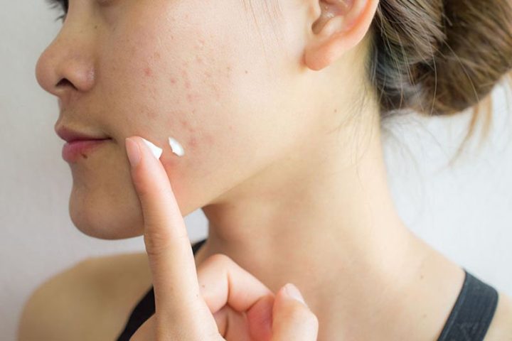 Bôi Kem Trị Mụn Khi Nào Để Đạt Hiệu Quả Tối Ưu Nhất?