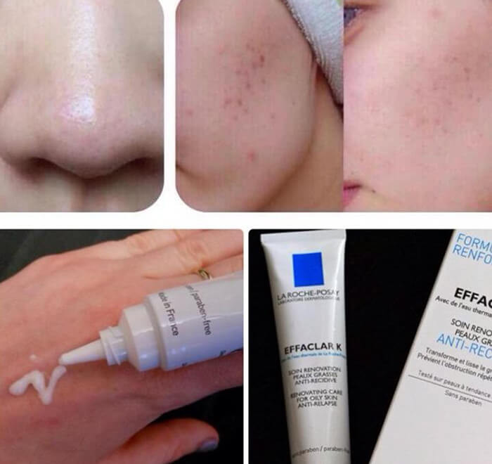 Thuốc Chấm Mụn La Roche Posay: Hướng Dẫn Sử Dụng & Đánh Giá Chi Tiết