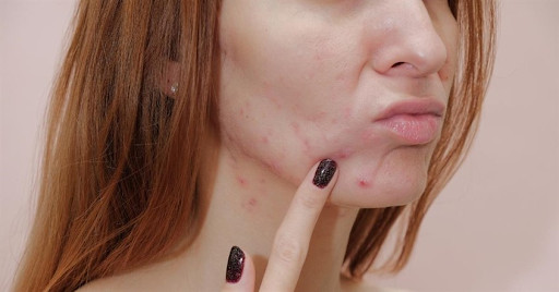 Kích ứng da và mắt là hậu quả thường gặp khi dùng phấn mắt hết hạn