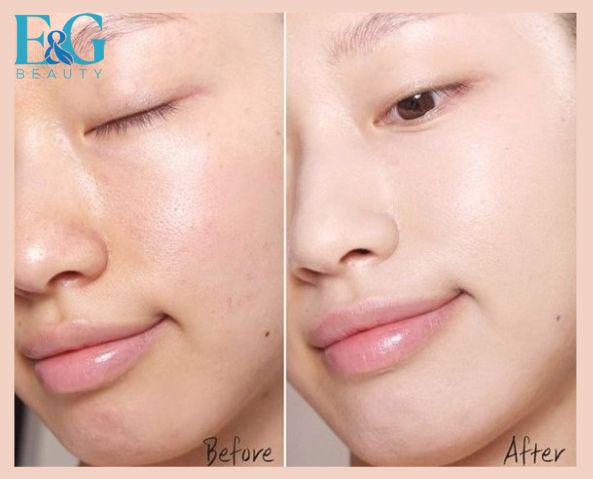 Làn da trước và sau khi áp dụng cách dưỡng ẩm cho da khô tại nhà hiệu quả