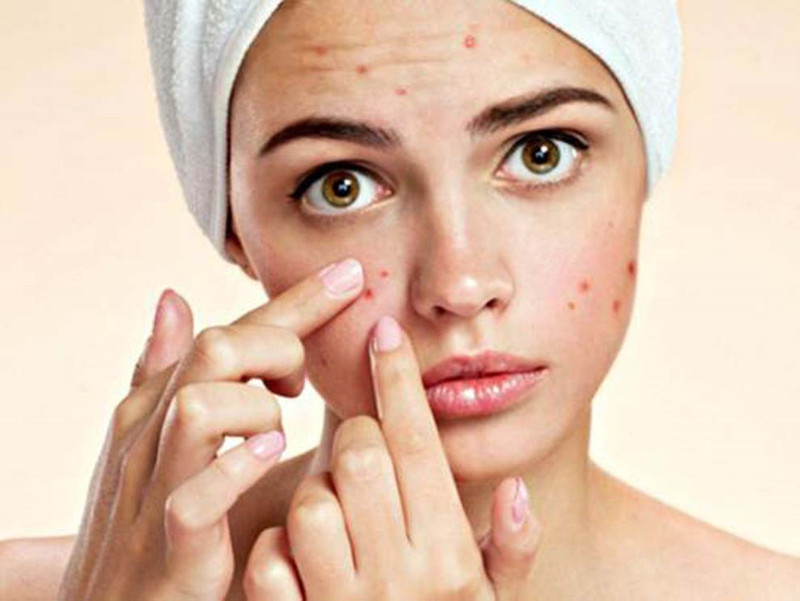 Làn da tuổi dậy thì dễ gặp các vấn đề mụn, ảnh hưởng đến việc trở nên xinh đẹp