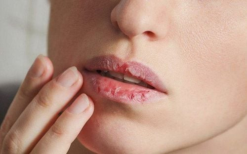 Lợi ích tẩy tế bào chết môi tại nhà