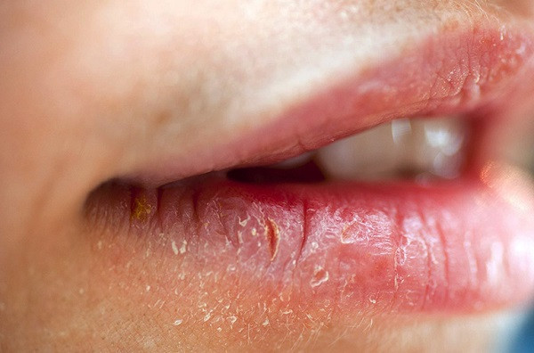 Lột Da Môi Có Sao Không? Nguyên Nhân và Giải Pháp Chăm Sóc Hiệu Quả