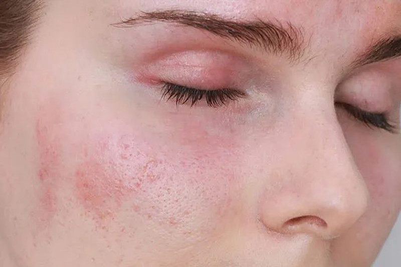 Lột mụn xong nên làm gì để xử lý da mẩn đỏ, lỗ chân lông to