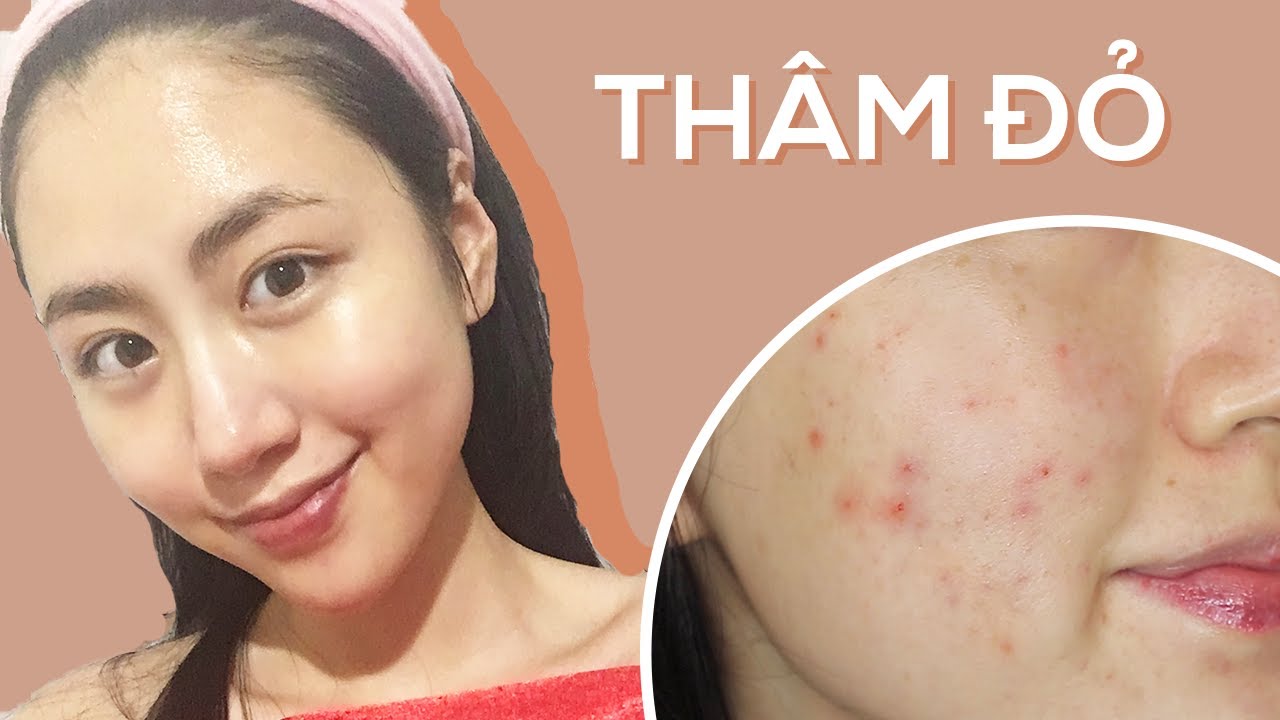 Cách Trị Vết Đỏ Sau Khi Nặn Mụn An Toàn, Hiệu Quả Nhất Cách Trị Vết Đỏ Sau Khi Nặn Mụn An Toàn, Hiệu Quả Nhất