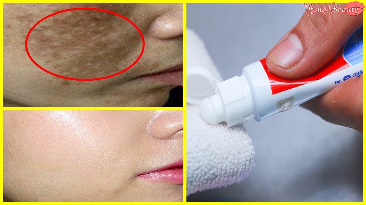 Trị Nám Bằng Kem Đánh Răng: Hiệu Quả, An Toàn Và Lưu Ý Cần Biết