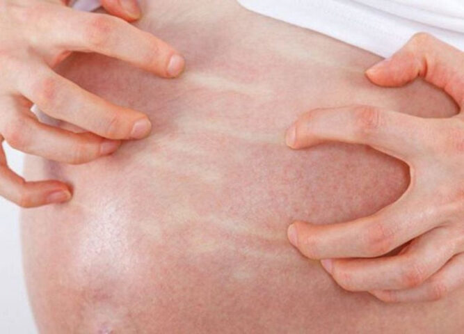 Mẹ bầu lo lắng vì bị dị ứng thực phẩm trong thai kỳ