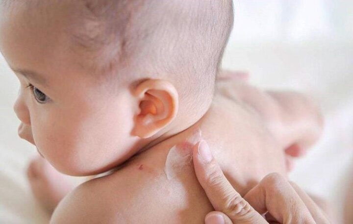Khô da ở trẻ sơ sinh: Nguyên nhân, Cách chăm sóc và Phòng ngừa toàn diện