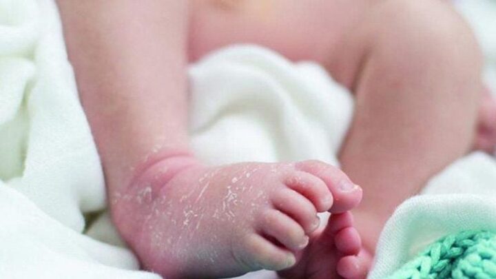 Da khô ở trẻ sơ sinh có thể là biểu hiện của bệnh vảy cá