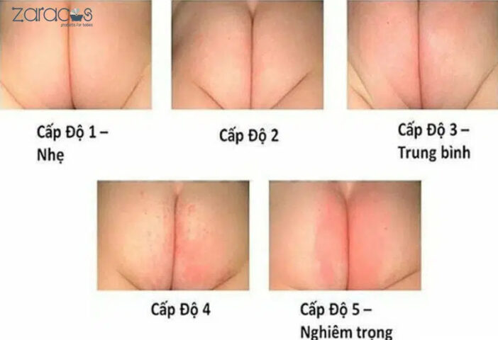 Một em bé đang khóc, có thể do khó chịu từ chiếc bỉm đầy và bẩn gây ra hăm tã, ảnh hưởng đến giấc ngủ và tâm trạng.