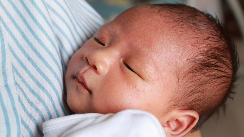 Em bé bị nổi mẩn đỏ trên mặt: Nguyên nhân, cách xử lý và phòng ngừa hiệu quả