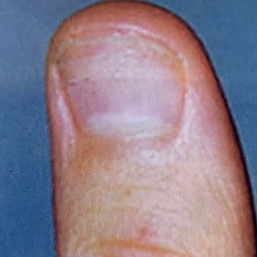 mút ngón tay khiến tay bị to