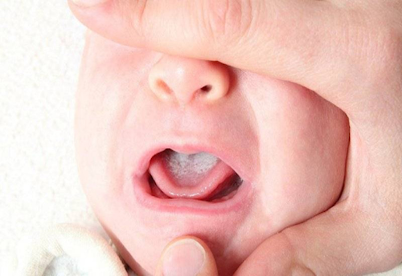 Rơ Lưỡi Cho Trẻ Sơ Sinh: Tầm Quan Trọng & Hướng Dẫn Chi Tiết