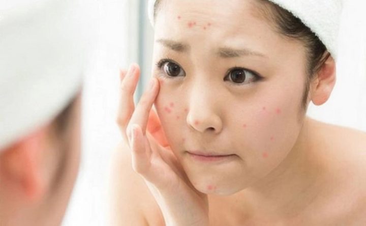 Bị Mụn Nên Uống Vitamin Gì? Hướng Dẫn Chi Tiết Để Có Làn Da Khỏe Mạnh