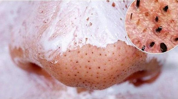Cách Trị Mụn Bằng Muối Và Kem Đánh Răng: Phương Pháp Hiệu Quả Hay Rủi Ro?