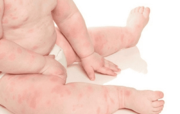 Phản ứng phát ban, mẩn ngứa trên da là cách nhận biết trẻ hợp sữa công thức hay không
