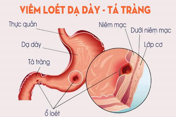 Phòng ngừa viêm loét dạ dày bằng sữa chua chứa lợi khuẩn tốt cho hệ tiêu hóa