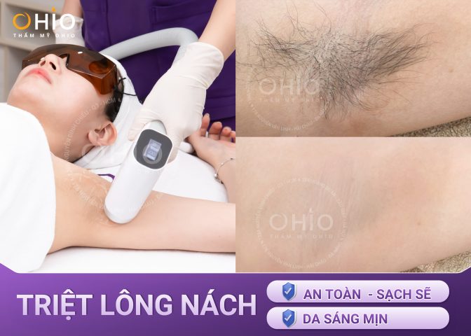 Triệt Lông Nách Những Điều Cần Biết: Hướng Dẫn Chuyên Sâu Từ A-Z