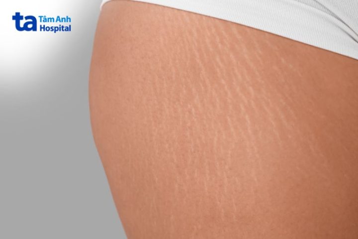 Rạn Da Mông Tuổi Dậy Thì: Nguyên Nhân, Cách Khắc Phục Hiệu Quả