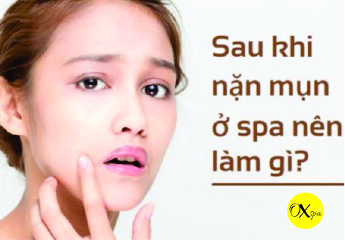 Sau khi nặn mụn có nên bôi kem trị mụn để phục hồi da