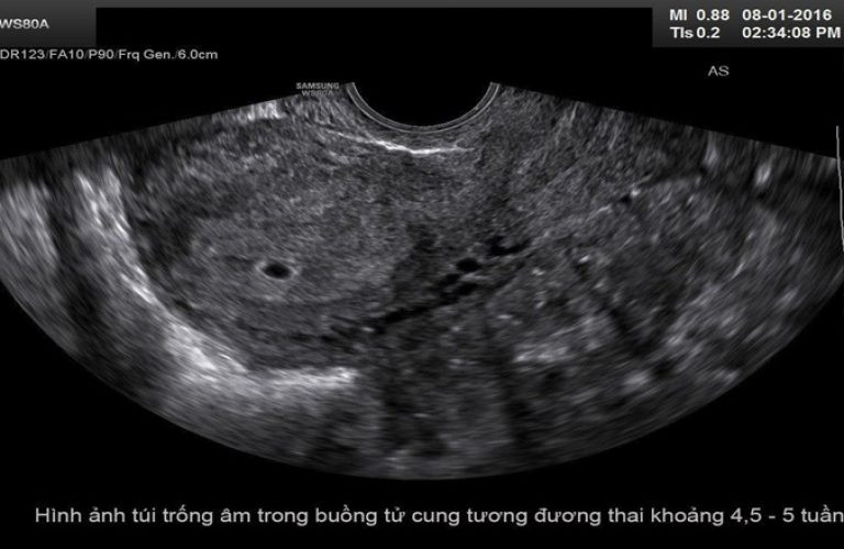 Siêu âm thai nhi 1 tuần tuổi chưa thể nhìn thấy rõ ràng