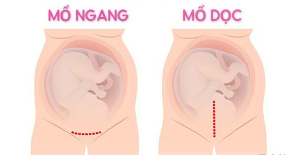 Sinh Mổ Lần 3 Mổ Dọc Hay Ngang: Giải Đáp Chi Tiết Cho Mẹ Bầu
