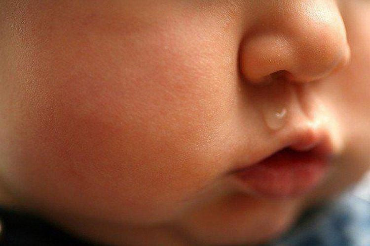 Sổ mũi là một trong các triệu chứng cảm lạnh ở trẻ nhỏ