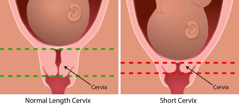 Dấu hiệu nhận biết cổ tử cung mở và bí quyết sinh nở dễ dàng