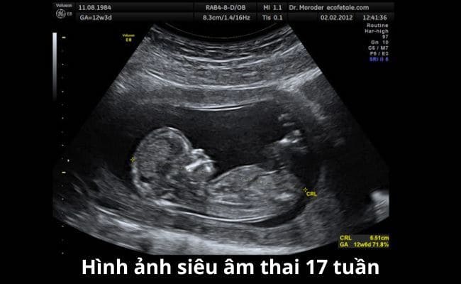 Thai 17 Tuần Nặng Bao Nhiêu Gam: Cẩm Nang Toàn Diện Về Sự Phát Triển Của Bé Và Mẹ