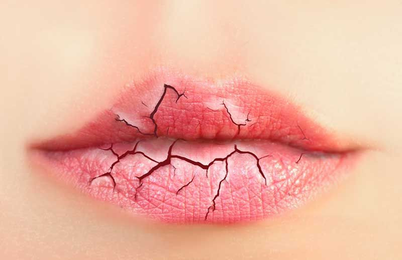Thiếu Vitamin B2 sẽ gây nứt môi, một trong những dấu hiệu khi Vitamin B2 có trong thực phẩm nào không đủ