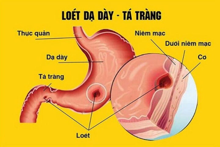 Đau Dạ Dày Có Nên Ăn Sữa Chua: Hướng Dẫn Chi Tiết