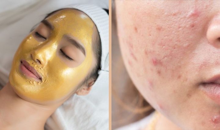 Cấp Ẩm Cho Da Dầu Mụn Hiệu Quả: Chuyên Gia Khuyên Dùng