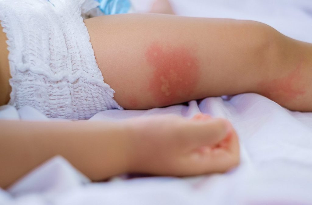 Trẻ Bị Muỗi Đốt Sưng Đỏ: Nguyên Nhân, Nguy Hại và Cách Xử Lý Hiệu Quả