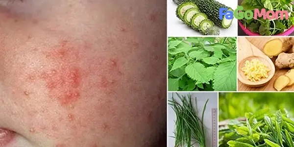 Bé Bị Rôm Sảy Tắm Lá Gì An Toàn Và Hiệu Quả Nhất?