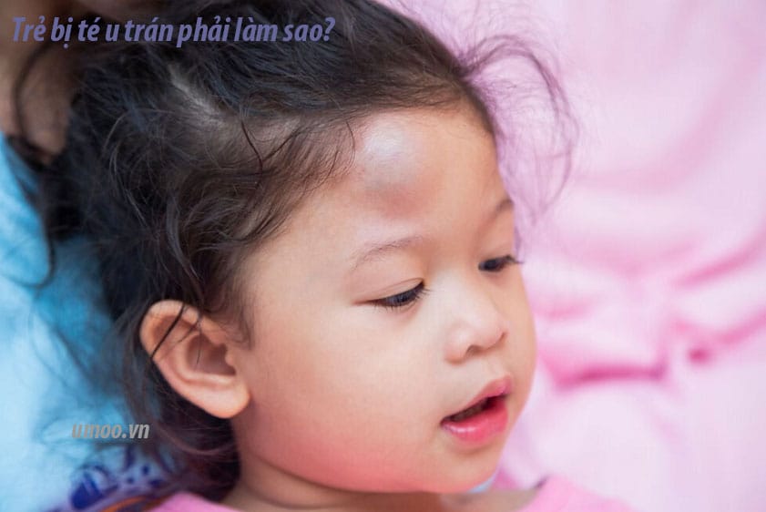 Trẻ Bị Té U Trán Phải Làm Sao: Hướng Dẫn Xử Lý Đúng Cách và Dấu Hiệu Nguy Hiểm