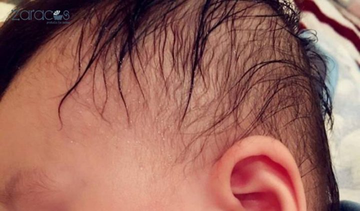 Trẻ Bị Ra Mồ Hôi Trộm: Nguyên Nhân, Dấu Hiệu và Cách Xử Lý Hiệu Quả