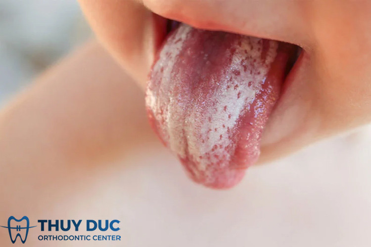 Cách Rơ Lưỡi Bằng Rau Ngót Cho Bé Đúng Chuẩn, An Toàn