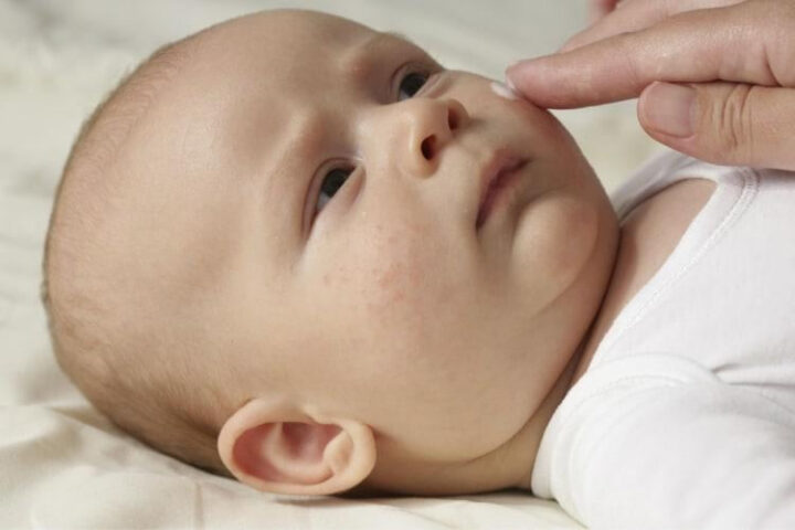 Trị mụn sữa ở trẻ sơ sinh: Bôi thuốc an toàn theo chỉ định bác sĩ
