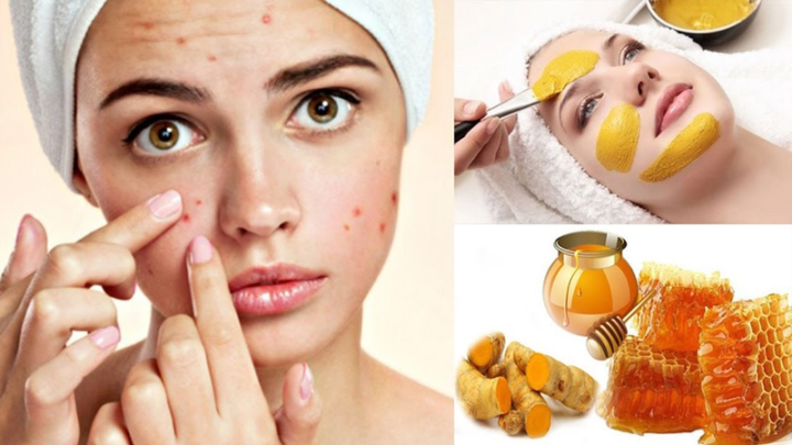 Cách Trị Mụn Tại Nhà Bằng Mật Ong An Toàn & Hiệu Quả Cách Trị Mụn Tại Nhà Bằng Mật Ong An Toàn & Hiệu Quả - image 1