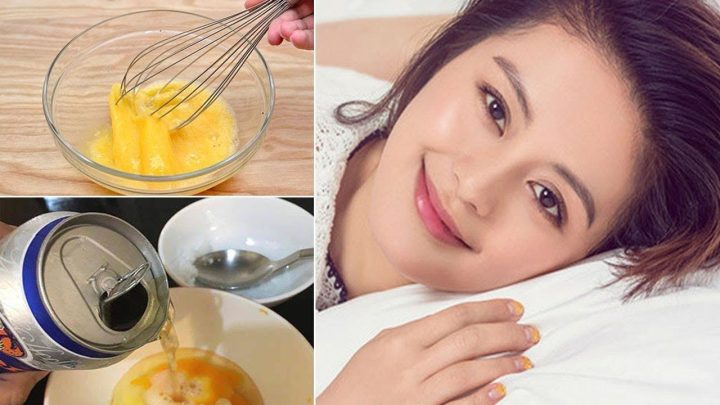 Cách Trị Gàu Mảng Tại Nhà Hiệu Quả và An Toàn Tuyệt Đối