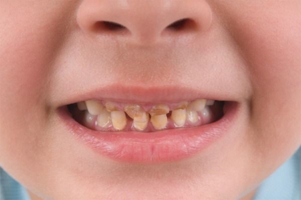 Trẻ 15 Tháng Tuổi Bị Vàng Răng: Nguyên Nhân và Giải Pháp Hiệu Quả Trẻ 15 Tháng Tuổi Bị Vàng Răng: Nguyên Nhân và Giải Pháp Hiệu Quả