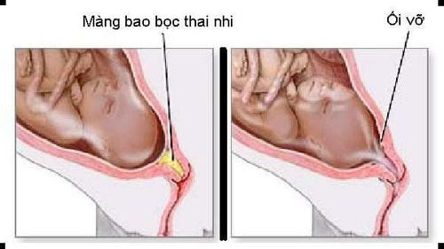 Vỡ ối non gây nguy hiểm cho sự phát triển của thai nhi