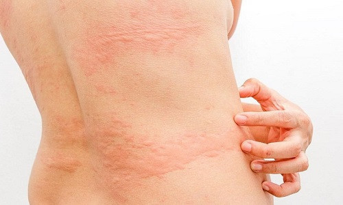 Vùng da bụng bị nổi mẩn đỏ và ngứa do bí bách khi sử dụng nịt bụng không đúng chất liệu hoặc quá lâu.