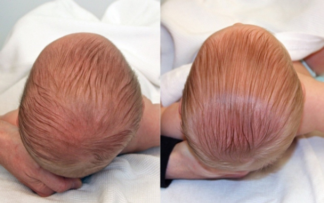 Cách Xoa Đầu Cho Trẻ Bị Méo Đầu An Toàn & Hiệu Quả Cách Xoa Đầu Cho Trẻ Bị Méo Đầu An Toàn & Hiệu Quả