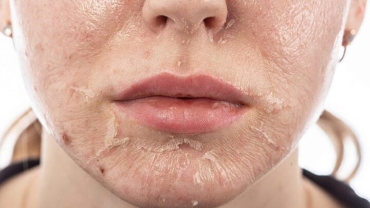 Sau khi peel da làn da sẽ trở nên mỏng, yếu ớt và rất nhạy cảm