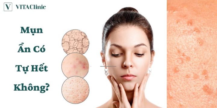 Mụn ẩn có tự hết không? Chuyên gia giải đáp và hướng dẫn điều trị