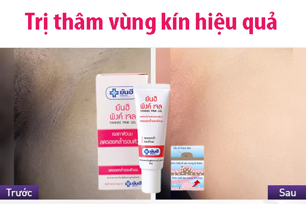 Cách làm vùng kín hết thâm hiệu quả an toàn tại nhà