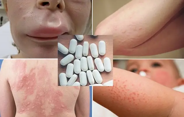 Cách dùng thuốc chống dị ứng an toàn